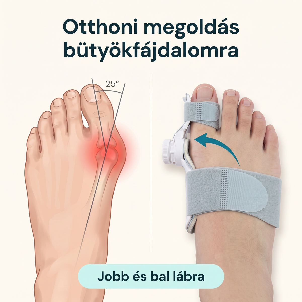 Bütykös láb és a fehér bütyökkorrigáló a lábon, otthoni megoldás bütyökfájdalomra