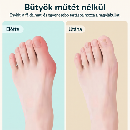 Rajzolt láb előtte és utána, bütyök műtét nélkül