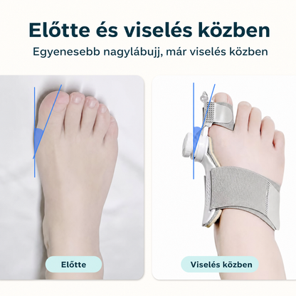 Bütykös láb előtte és a bütyökkorrigálóval viselés közben